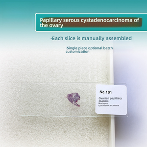 Cistadenocarcinoma seroso papilar ovárico de Educación Superior, <span class=keywords><strong>Ciencia</strong></span> Médica, sección patológica, juego de portaobjetos de microscopio de vidrio - Product Image 4