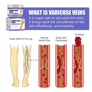 Allevia la vagina da flebite migliora la circolazione sanguigna crema per le vene Varicose - Product Image 4