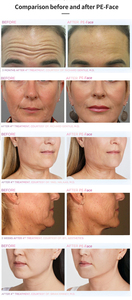 Professional Design Pe Face Slimming Slim Facial Muscle Face Lifting Machine Skin Tightening No Manual Operation Required - Product Image 5