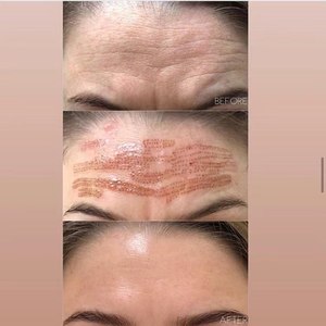 Dispositivo Coreano de Plasma Jet para Lifting Facial, Eliminación de Manchas y Lunares, Lifting de Párpados, Eliminación de Pecas y Limpieza Profunda - Product Image 6