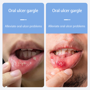 น้ำยาบ้วนปากสำหรับแผลในปาก บรรเทาอาการปวดแผลในปากได้อย่างรวดเร็ว น้ำยาบ้วนปากสูตรพิเศษสำหรับพนักงานออฟฟิศที่มีอาการ<span class=keywords><strong>ร้อน</strong></span><span class=keywords><strong>ใน</strong></span>ร่างกาย - Product Image 5