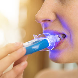 Kit professionnel de gel de blanchiment des dents de seringue de gels de blanchiment des dents 35% cp en gros - Product Image 5