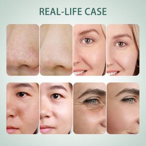 Máquina Facial 6 en 1 Super Bubble con Pantalla Táctil de 7 Pulgadas para Limpieza Facial, Rejuvenecimiento de la Piel, Oxígeno Jet y Oxigenoterapia Facial - Product Image 6