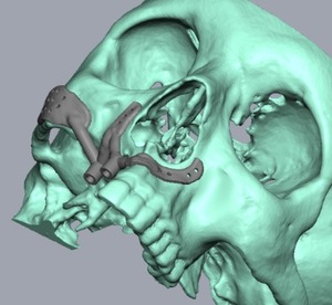 ซัพพลายเออร์อินเดียจำหน่ายรากฟันเทียมไทเทเนียมแบบ Maxillary พร้อมดีไซน์เกลียวเรียวเพื่อการยึดติดแน่นสำหรับการทดแทนฟันบน มีจำหน่ายแล้ว - Product Image 1