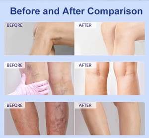 Sản phẩm mới tĩnh mạch sửa chữa kem cho giãn tĩnh mạch cứu trợ đau đớn mạch máu ở chân - Product Image 5