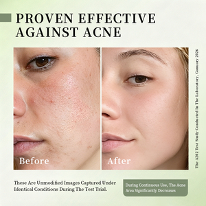 Crema Viso all'<span class=keywords><strong>Acido</strong></span> <span class=keywords><strong>Salicilico</strong></span> per Rimozione <span class=keywords><strong>Acne</strong></span> e Idratazione, Ideale per Studenti - Product Image 6