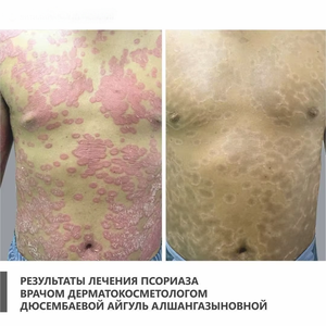 KN-4005 เครื่องฉายแสงบำบัดโรคด่างขาวแบบครอบคลุมร่างกาย 311 นาโนเมตร แสงยูวีบี ปูวา สำหรับรักษาโรคด่างขาวด้วยแสงยูวีบี 311 นาโนเมตร - Product Image 6