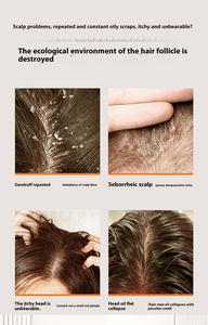 Kondisioner sampo Anti ketombe profesional 1% <span class=keywords><strong>Selenium</strong></span> sulfida kontrol minyak nutrisi untuk menghilangkan gatal perawatan kulit kepala berminyak rumah - Product Image 4