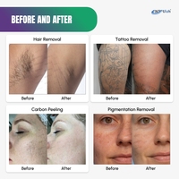 Appareil d'épilation au laser à diode 808 nm et d'élimination des tatouages au laser Nd:YAG Q-Switched à 2 poignées ISO13485