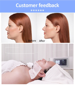Máquina Portátil de Criolipólisis de Metal y ABS para Adelgazar y Congelar Grasa con Vacío para Reducción de Papada, Dispositivo de Belleza Facial - Product Image 6