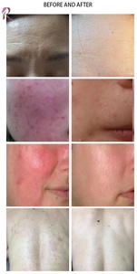Máquina de Rejuvenecimiento Facial con <span class=keywords><strong>Plasma</strong></span> Vertical, Limpieza Profunda de la Piel, Antiarrugas, Dispositivo de Belleza para el Cuidado de la Piel - Product Image 4