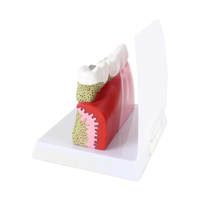 Modèle de pathologie dentaire Modèles de dents dentaires Modèle d'anatomie de la carie en plastique Équipement éducatif détachable médical Formation des dents