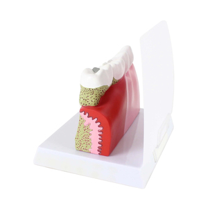 Modèle de pathologie dentaire Modèles de dents dentaires Modèle d'anatomie de la carie en plastique Équipement éducatif détachable médical Formation des dents - Product Image 5