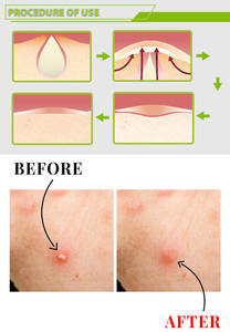 Parche Hidrocoloide Personalizado OEM para el Cuidado de la Piel, 12 mm, Transparente, Milagroso para Cubrir el Acné, Adhesivo de Colágeno para Heridas, Antienvejecimiento, Privado - Product Image 5