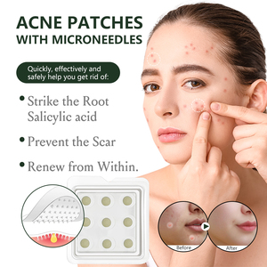 Série de micro-aiguilles faciales en stock usine, comprenant des masques pour les yeux à micro-aiguilles, des patchs anti-acné, des patchs pour le front et des masques pour les lèvres - Product Image 5