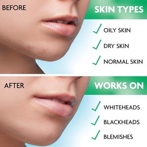 Chiaro 4 toppe <span class=keywords><strong>per</strong></span> foglio di forma rotonda brufolo di <span class=keywords><strong>acne</strong></span> patch con custodia in plastica con specchio - Product Image 6