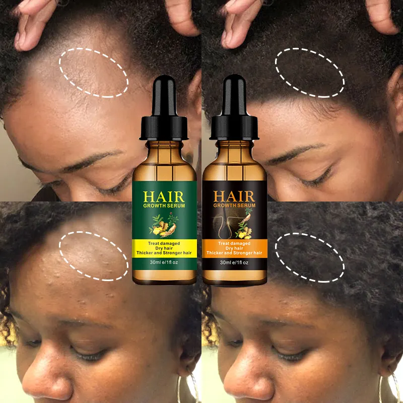 Ricrescita Anti perdita di Formula naturale dell'oem 100% per il siero calvo dei capelli Anti perdita di capelli di erbe che aumenta il Serun dell'olio di crescita dei capelli