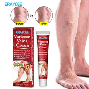 Natural Treatment Spider Varicose Veine Miracle Chinese Herbal Medicine Varicosity Angiitis Removal Phlebitis legs Veins