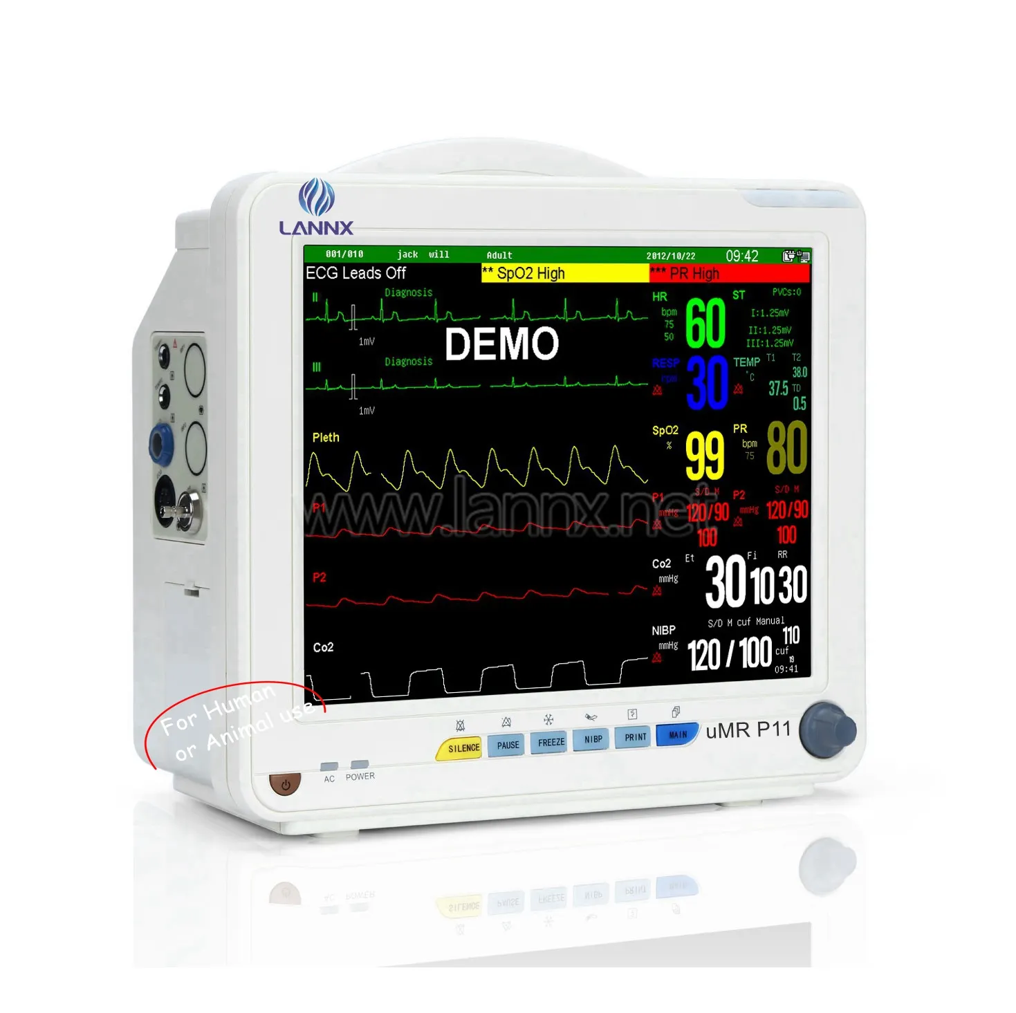 Lannx umr P11 chất lượng tốt nhất đảm bảo đa-thông số màn hình cảm ứng ECG dạng sóng tương thích bệnh nhân giám sát hệ thống màn hình