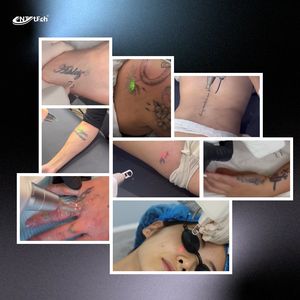 Le tatouage permanent portatif de commutateur de Q peut être enlevé la machine portative de retrait de tatouage de laser de Nd Yag - Product Image 4