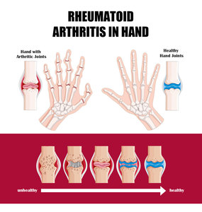Crème articulaire Perfectx pour soulager les douleurs au genou, à la colonne vertébrale lombaire, aux jambes et au cou, crème de soin des articulations active pour la santé du corps, 30 g - Product Image 6