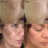 Crème éclaircissante anti-taches à l'astragale pour le visage – Élimine les taches brunes, le mélasma, atténue la mélanine, les cicatrices d'acné, anti-âge, illumine la peau noire