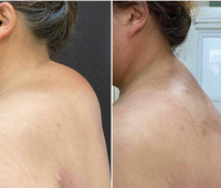 Machine de liposuccion Vaser 980nm Diode Laser Lipolyse Removal Cellulite Endo Laser Lifting