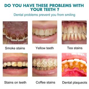 EELHOE Blanchiment des dents naturel Élimine les taches de fumée Mauvaise haleine Nettoie le tartre <span class=keywords><strong>Anti</strong></span>-précipitation <span class=keywords><strong>pigmentaire</strong></span> Soins bucco-dentaires Laque dentaire - Product Image 5