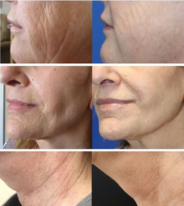 Appareil de remodelage corporel haute fréquence, lifting du visage, élimination de la cellulite, machine de soin de la peau anti-âge - Product Image 5