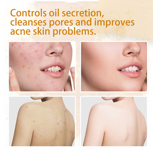 Jabón de cúrcuma YURHERSU, Ácido Kójico, blanqueamiento de piel Natural, cúrcuma, jabón de cúrcuma hecho a mano - Product Image 4