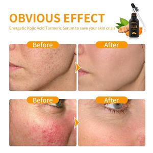 Suero Natural de Ácido Kójico y Cúrcuma para Corregir Manchas Oscuras, Esencia Facial Iluminadora, Alivio de Imperfecciones, Cuidado de Granos, Marca Privada - Product Image 4