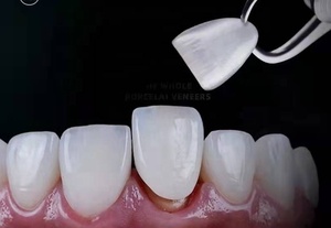 Kits de Carillas Dentales de Alta Calidad en Oferta, Carillas Dentales Ultrafinas, Pueden Blanquear los Dientes - Product Image 4