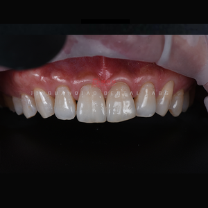 Implantes personalizados Solución de reemplazo dental Implantes dentales con el cuidado adecuado - Product Image 1