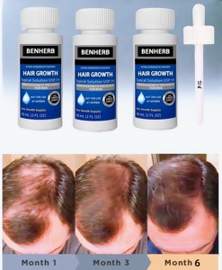 Le <span class=keywords><strong>meilleur</strong></span> traitement contre la perte de <span class=keywords><strong>cheveux</strong></span> pour les hommes : stimule la croissance des <span class=keywords><strong>cheveux</strong></span> de 5 % |   Soins capillaires naturels |   Améliorer la vitalité des follicules pileux - Product Image 4