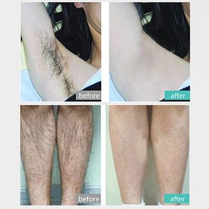 เครื่องเลเซอร์ความงาม ไดโอดเลเซอร์ สำหรับกำจัดขนอย่างปลอดภัยและมีประสิทธิภาพ ไดโอดเลเซอร์กำจัดขน 808 นาโนเมตร - Product Image 5
