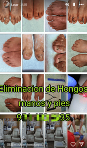 Dispositivo de tratamiento con láser <span class=keywords><strong>para</strong></span> <span class=keywords><strong>hongos</strong></span> <span class=keywords><strong>en</strong></span> las uñas de <span class=keywords><strong>los</strong></span> <span class=keywords><strong>pies</strong></span>, tratamiento de <span class=keywords><strong>hongos</strong></span> con láser <span class=keywords><strong>para</strong></span> uñas de <span class=keywords><strong>los</strong></span> <span class=keywords><strong>pies</strong></span>, podólogo profesional, uso de podólogo, Láser de onicomicosis - Product Image 4
