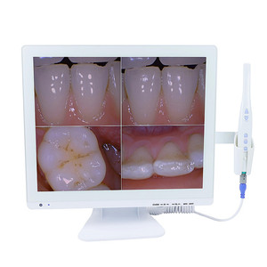 Sistema de Endoscopia Dental con Monitor de 17 Pulgadas, 800W Píxeles, Equipo Médico de Observación Oral - Product Image 3