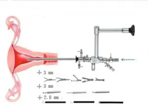 Máquina endovascular flexível para histeroscopia vaginal, conjunto de histeroscopia secor e histeroscopia transvaginal para escritório