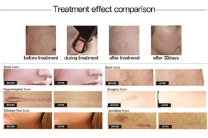 Máy laser CO2 Fractional loại bỏ sẹo, trẻ hóa da dùng trong thẩm mỹ viện năm 2025 - Product Image 6