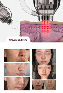 2025 מתקדם מכונת הרמת פנים ואקום <span class=keywords><strong>rf</strong></span> מכונת הרמת פנים עבור מסיר קמטים הגוף עם תקע לנו - Product Image 5
