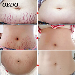 ครีมลบรอยแผลเป็นแบบยืดได้ครีมทาผิวผู้ใหญ่สีขาว3ปี OEM OEM OEM ฉลากส่วนตัว10ชิ้น