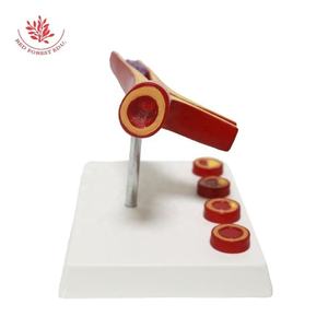 Modèle d'anatomie en PVC <span class=keywords><strong>vasculaire</strong></span> Matériau de haute qualité fait à la main Athériosclérose et thrombose Modèle de <span class=keywords><strong>pathologie</strong></span> des vaisseaux sanguins - Product Image 2