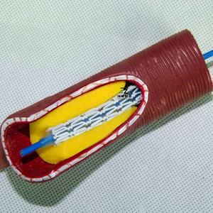 รูปแบบการสอนกระบวนการสาธิตการติดตั้งการใส่ท่อเลือดแบบขยายสำหรับหลอดเลือดของมนุษย์ - Product Image 3