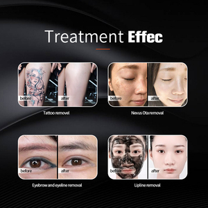 Máquina Láser de Picosegundos en Oferta, Eliminación de Pigmentación y Pecas, Rejuvenecimiento de la Piel, Equipo para Salón de Belleza - Product Image 4