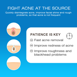 ครีมกำจัดสิวครีมกำจัดสิวสูตรบำรุงผิวกำจัดสิวเพื่อผิวขาว - Product Image 6