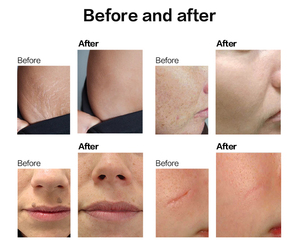 Lufenbeauty 4D Fracionário CO2 Dispositivo Pele Resurfacing Tratamento Vaginal Remoção De Estrias CO2 Máquina Laser Fracionado - Product Image 6