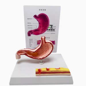 Modelo de Estómago con Estructura Patológica: Gastritis Atrofiada, Úlcera Perforada, Modelo de Sistema Digestivo Humano - Product Image 2
