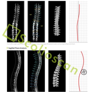 Ultrasound Spinal Assessment <strong>System</strong> 3D <strong>Analysis</strong> <strong>Software</strong> with AI Algorithm - Product Image 4