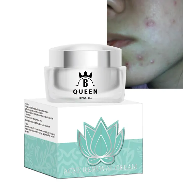 Beste Private Label Huidverzorging Anti Acne Whitening Gezicht Spot Behandeling Producten Puistje Acne Litteken Behandeling Verwijdering Weg Collageen B