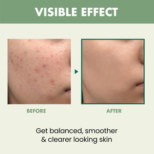 20กรัมเจลกำจัด<span class=keywords><strong>สิว</strong></span>น้ำมันทีทรีสิวกำจัดสิวอย่างรวดเร็วฉลากส่วนตัวกำหนดเองได้อย่างมีประสิทธิภาพ - Product Image 5